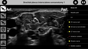 AnSo Anaesthesia Sonoanatomy screenshot 3